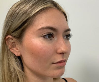 Fillers Before & After Gallery - Patient 148734684 - Image 2