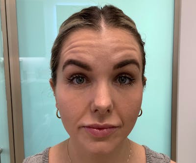 BOTOX  Before & After Gallery - Patient 149192875 - Image 1