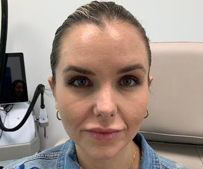 BOTOX  Before & After Gallery - Patient 149192875 - Image 2