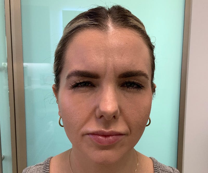 BOTOX  Before & After Gallery - Patient 149192875 - Image 3