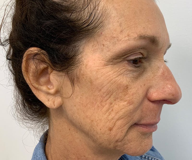 UltraClear Laser Before & After Gallery - Patient 150718204 - Image 3