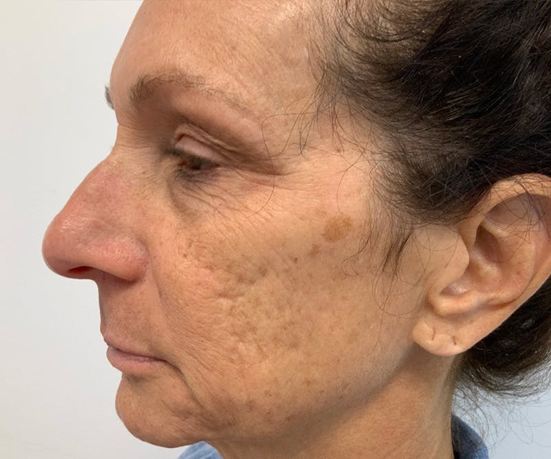 UltraClear Laser Before & After Gallery - Patient 150718204 - Image 1