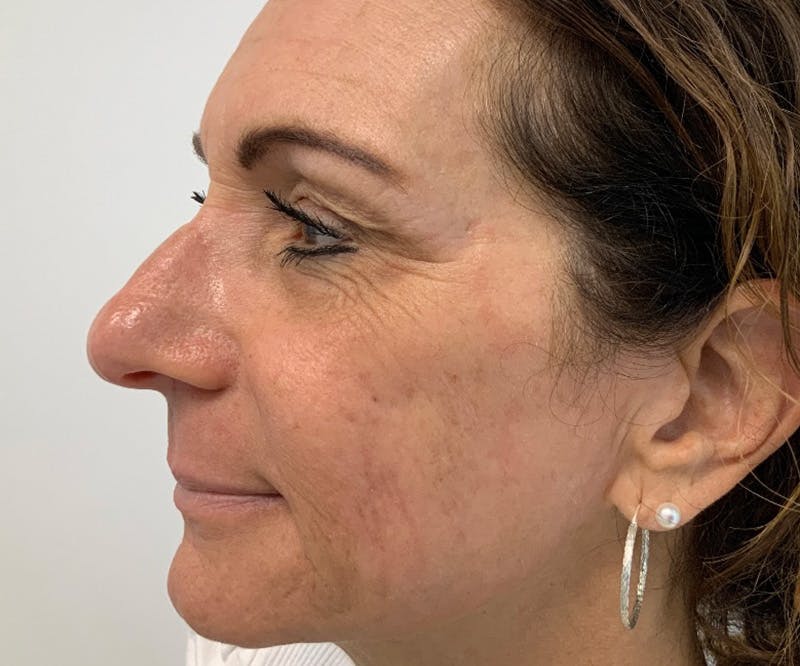 UltraClear Laser Before & After Gallery - Patient 150718204 - Image 2
