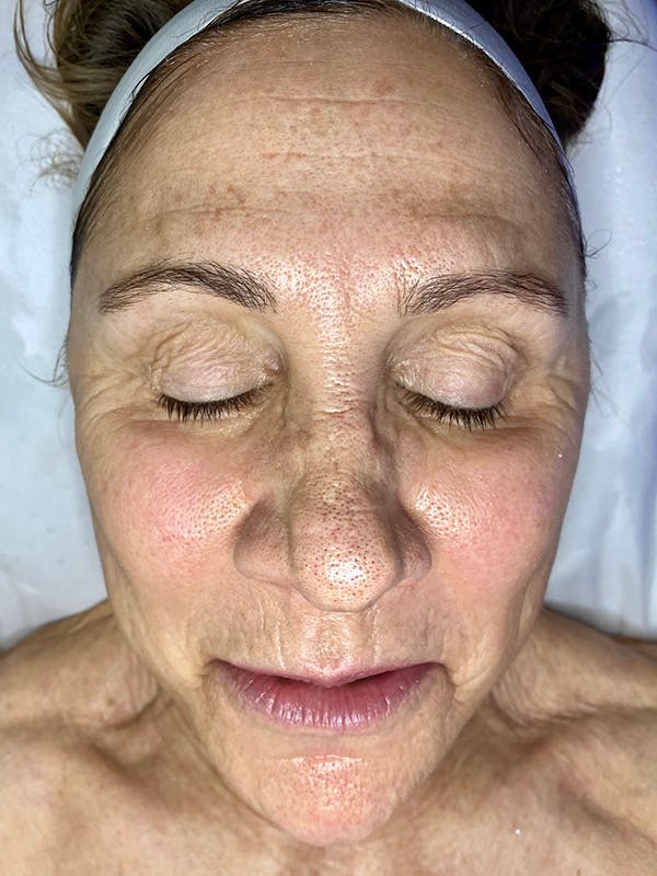 a before image of a female patient