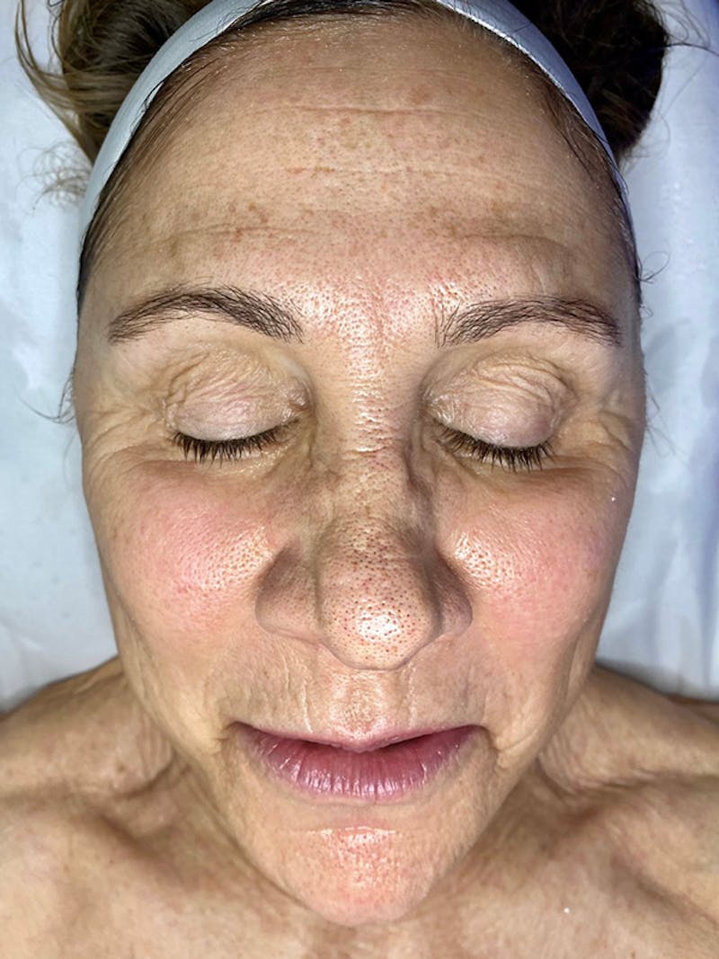 DiamondGlow Facial Before & After Gallery - Patient 150718205 - Image 1
