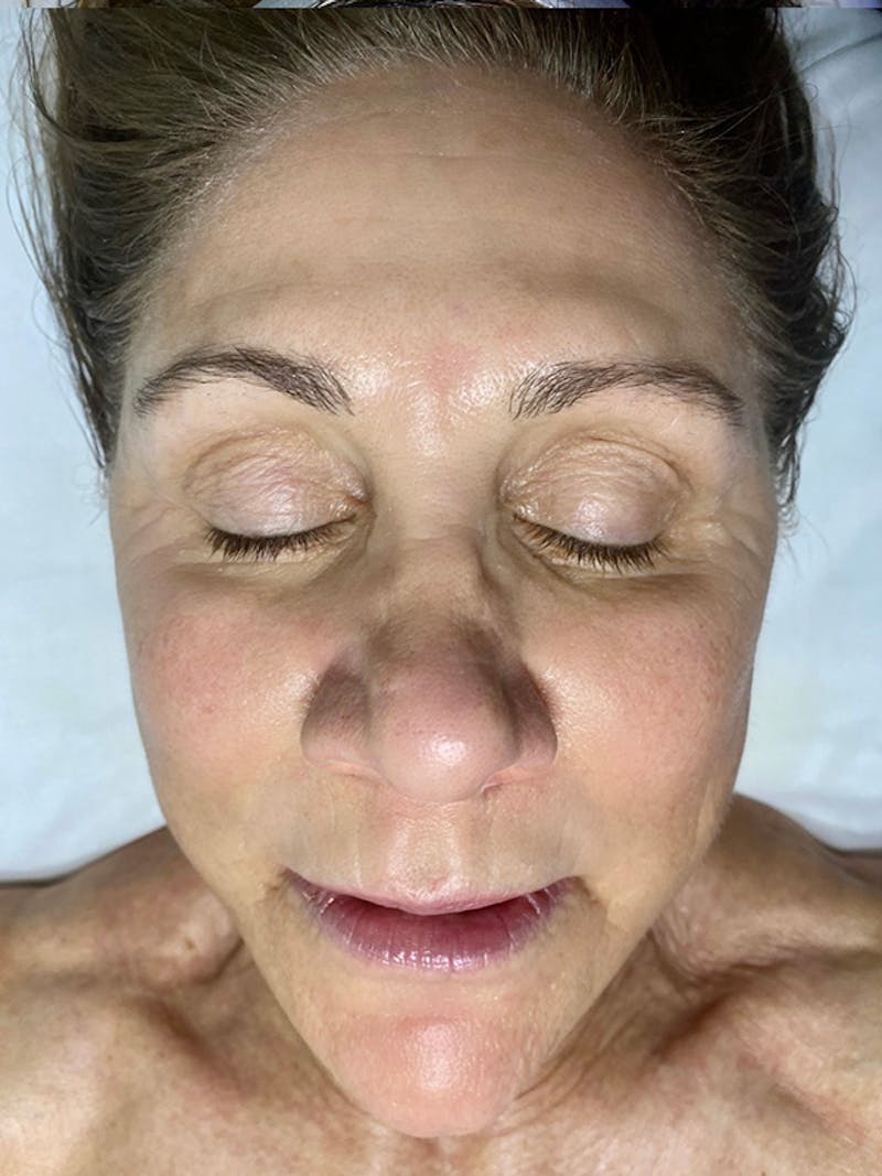 a female patient after their ipl photofacial