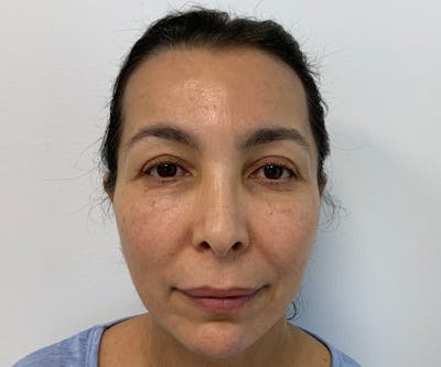 Fillers Before & After Gallery - Patient 166743217 - Image 1