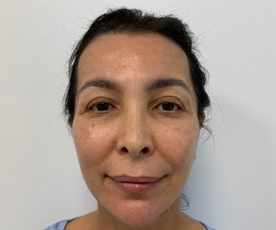 Fillers Before & After Gallery - Patient 166743217 - Image 2