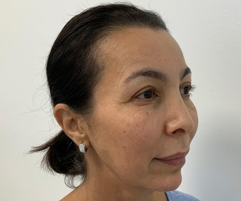 Fillers Before & After Gallery - Patient 166743217 - Image 3