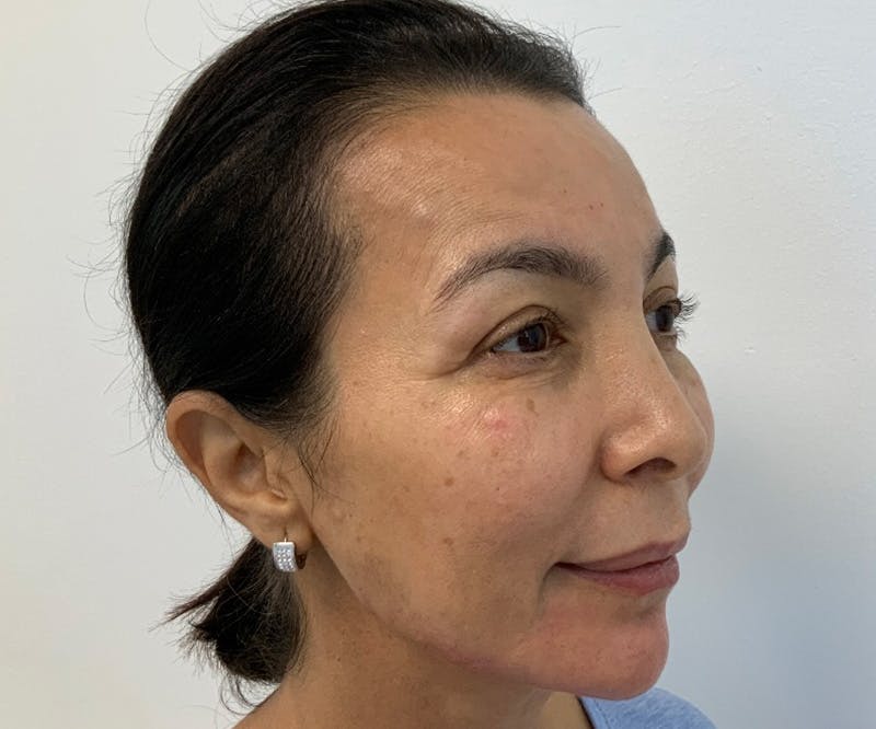 Fillers Before & After Gallery - Patient 166743217 - Image 4