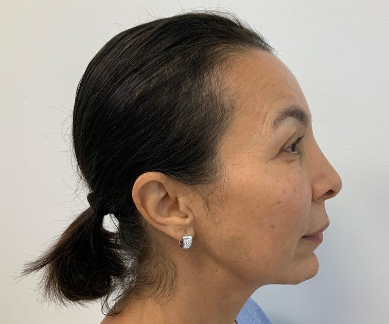 Fillers Before & After Gallery - Patient 166743217 - Image 5