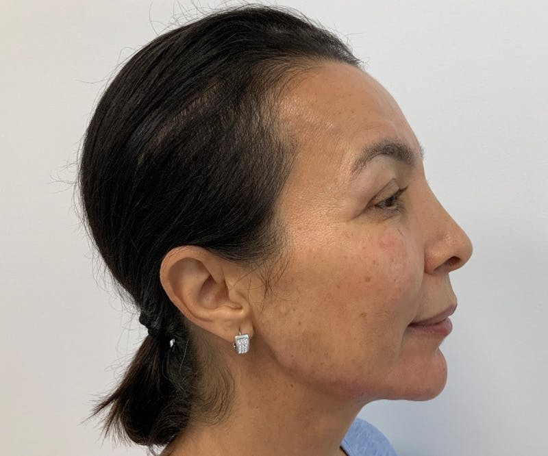 Fillers Before & After Gallery - Patient 166743217 - Image 6