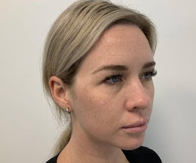 Fillers Before & After Gallery - Patient 295404 - Image 1