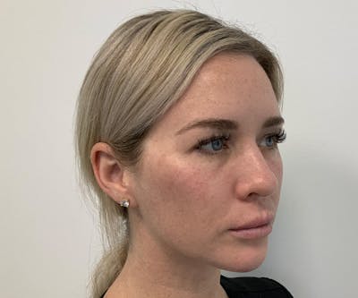 Fillers Before & After Gallery - Patient 295404 - Image 2