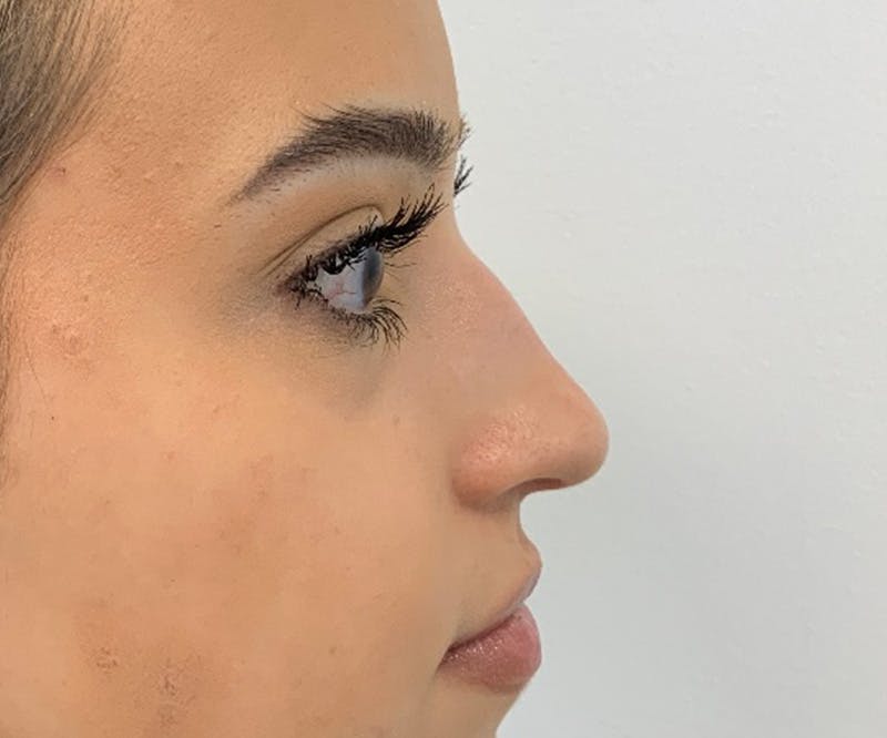 Fillers Before & After Gallery - Patient 288538 - Image 1