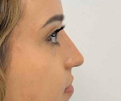 Fillers Before & After Gallery - Patient 288538 - Image 2