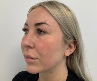 Fillers Before & After Gallery - Patient 262167 - Image 1