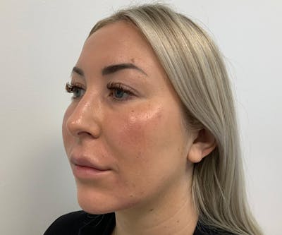 Fillers Before & After Gallery - Patient 262167 - Image 2