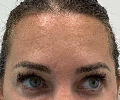 a female patient after botox