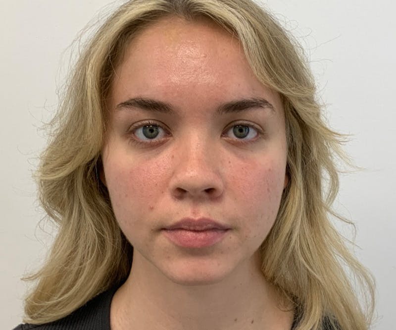 a before image of a female patient