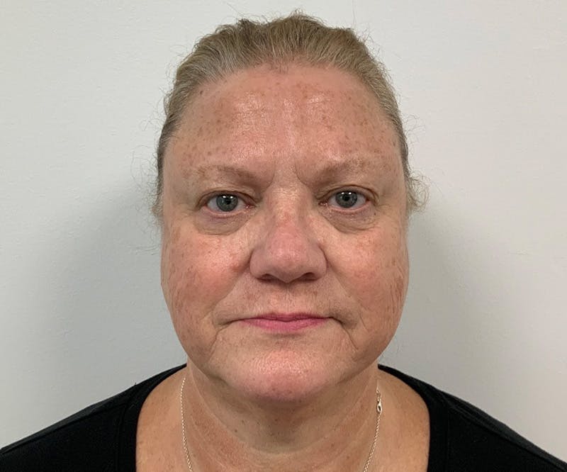 Fillers Before & After Gallery - Patient 139766 - Image 1