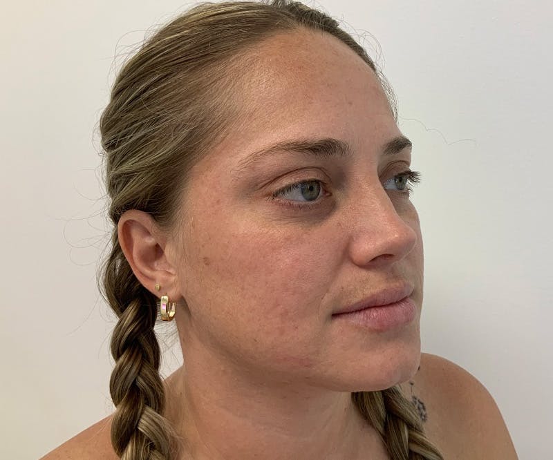 Fillers Before & After Gallery - Patient 796379 - Image 1