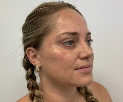 Fillers Before & After Gallery - Patient 796379 - Image 2