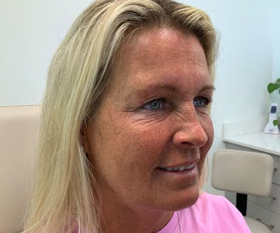BOTOX  Before & After Gallery - Patient 160511 - Image 2