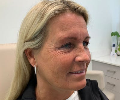 BOTOX  Before & After Gallery - Patient 160511 - Image 1