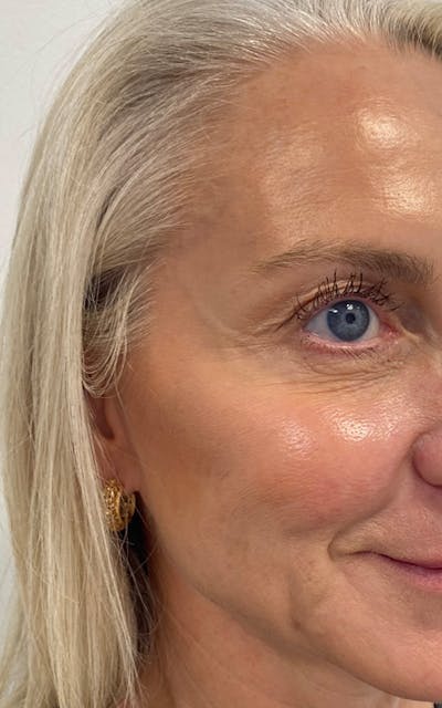 BOTOX  Before & After Gallery - Patient 834927 - Image 2