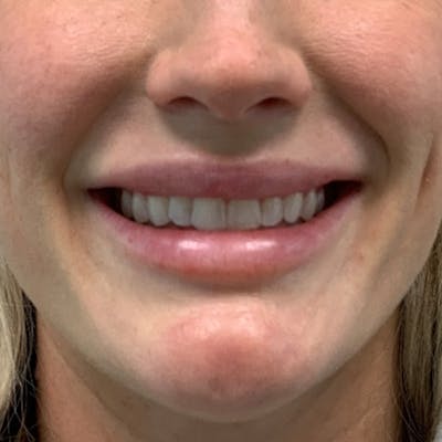Fillers Before & After Gallery - Patient 275792 - Image 2