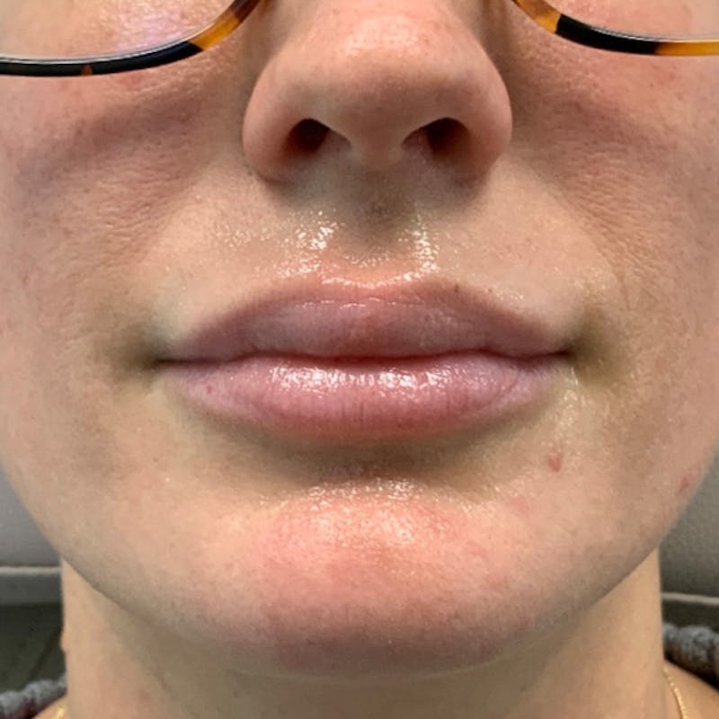 Fillers Before & After Gallery - Patient 275792 - Image 3