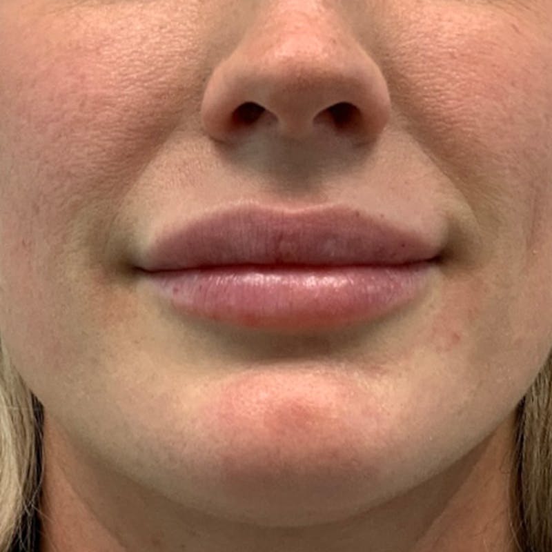Fillers Before & After Gallery - Patient 275792 - Image 4