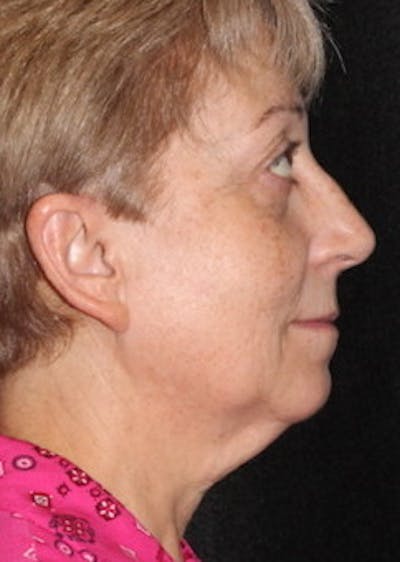 Facetite Before & After Gallery - Patient 106387018 - Image 1