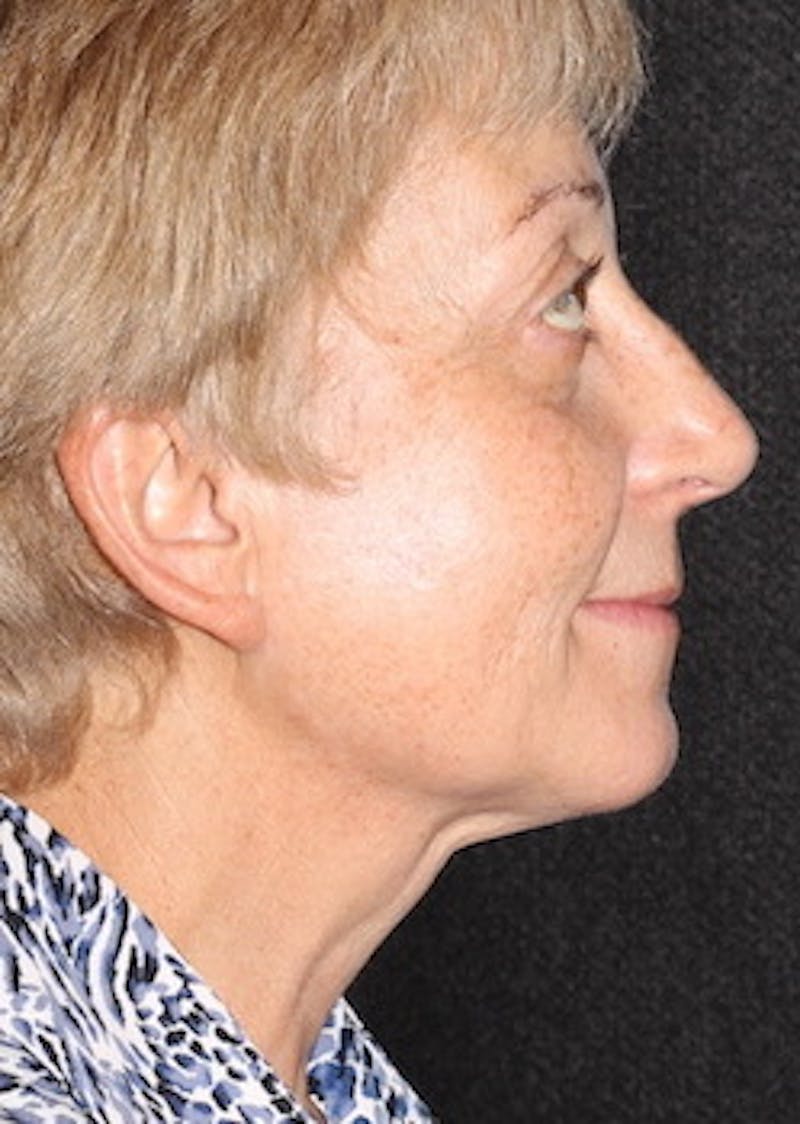 Facetite Before & After Gallery - Patient 106387018 - Image 2