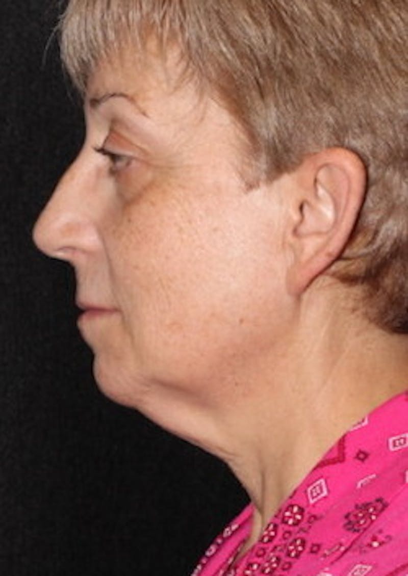 Facetite Before & After Gallery - Patient 106387018 - Image 9
