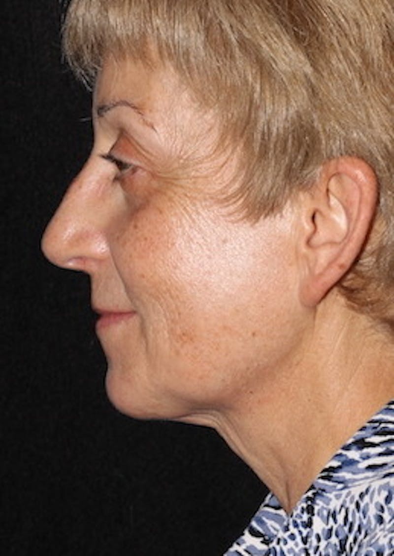 Facetite Before & After Gallery - Patient 106387018 - Image 10