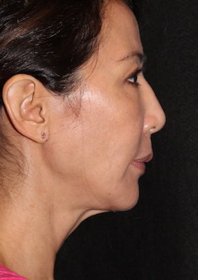 Facetite Before & After Gallery - Patient 106387062 - Image 2