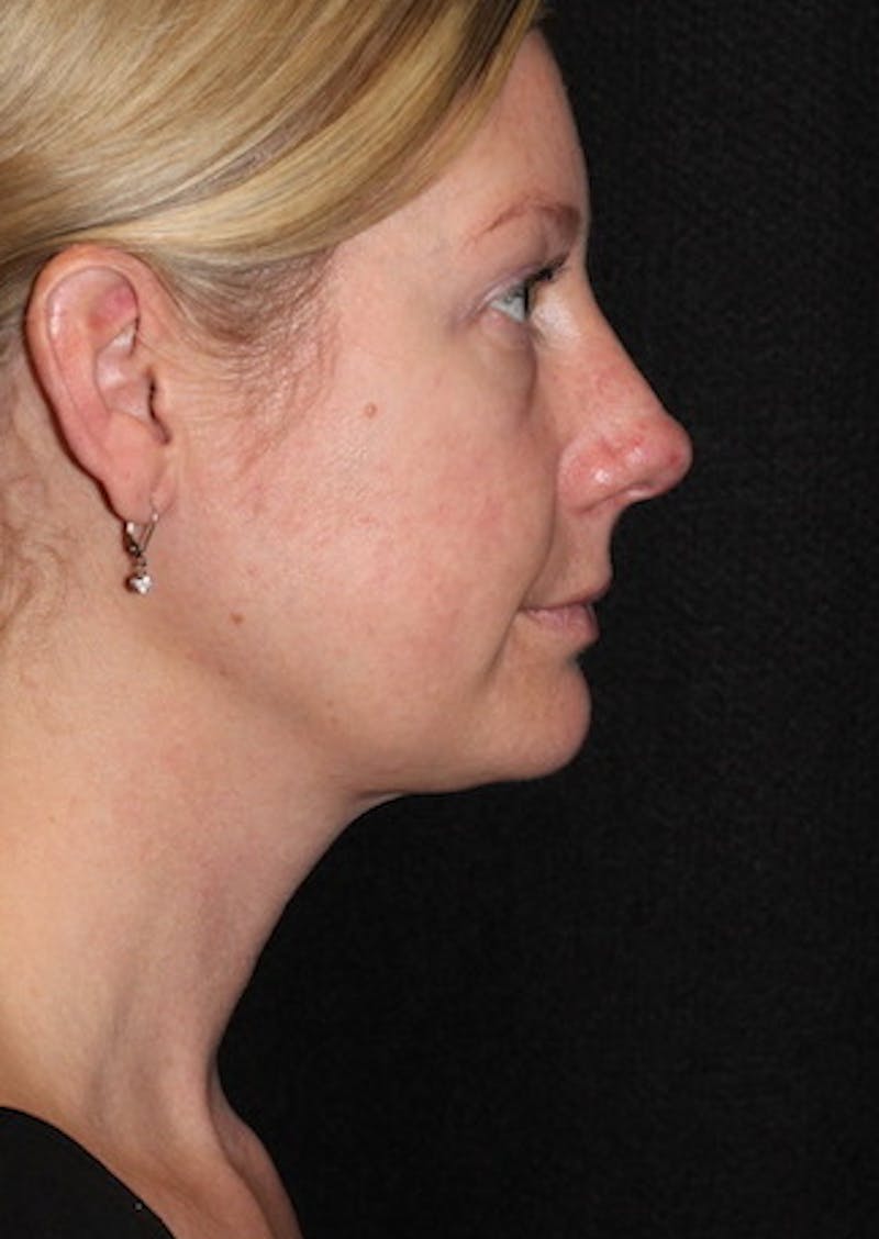 Facetite Before & After Gallery - Patient 106387107 - Image 2