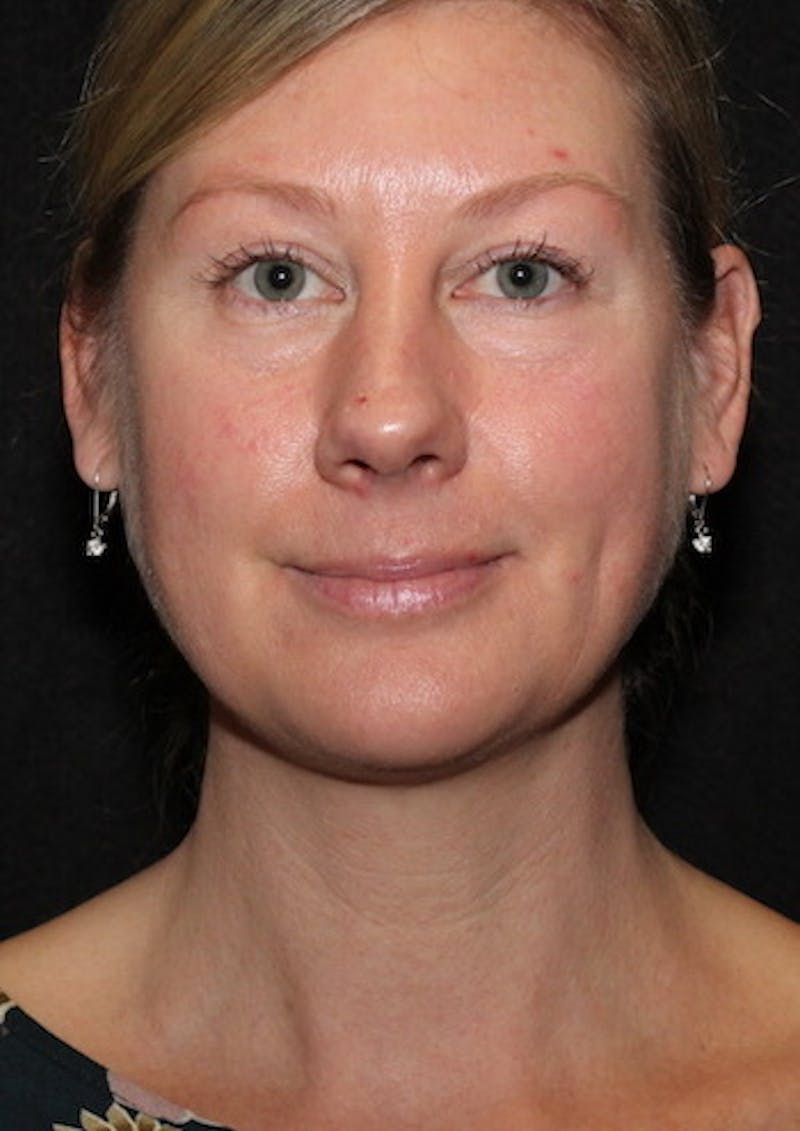 Facetite Before & After Gallery - Patient 106387107 - Image 5