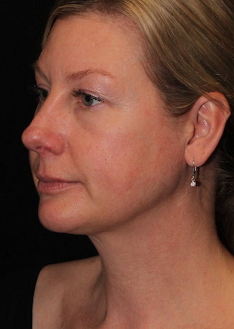 Facetite Before & After Gallery - Patient 106387107 - Image 8