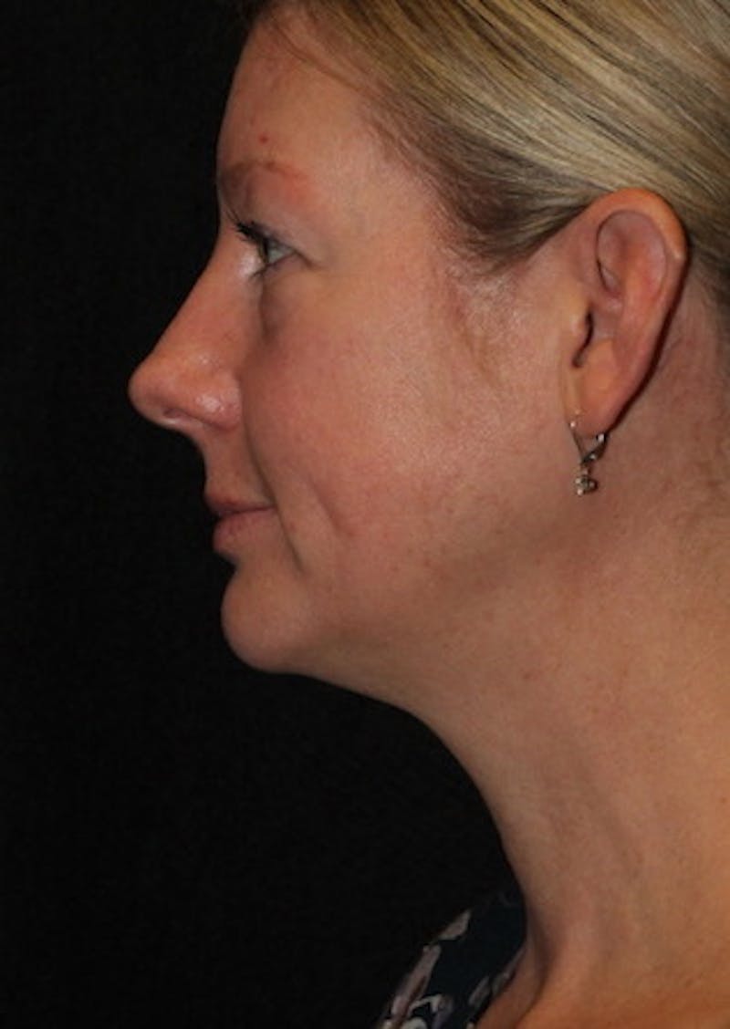 Facetite Before & After Gallery - Patient 106387107 - Image 9