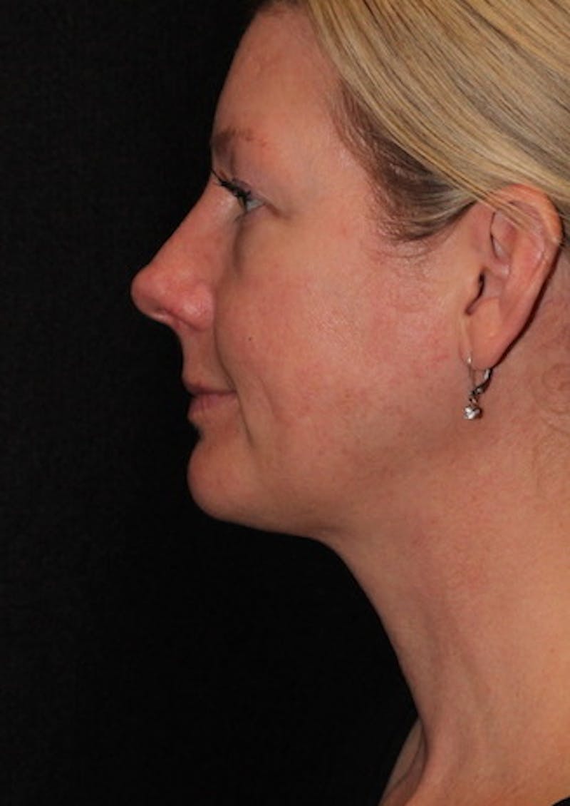 Facetite Before & After Gallery - Patient 106387107 - Image 10