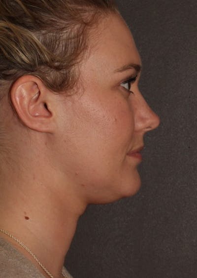 Facetite Before & After Gallery - Patient 106387115 - Image 1