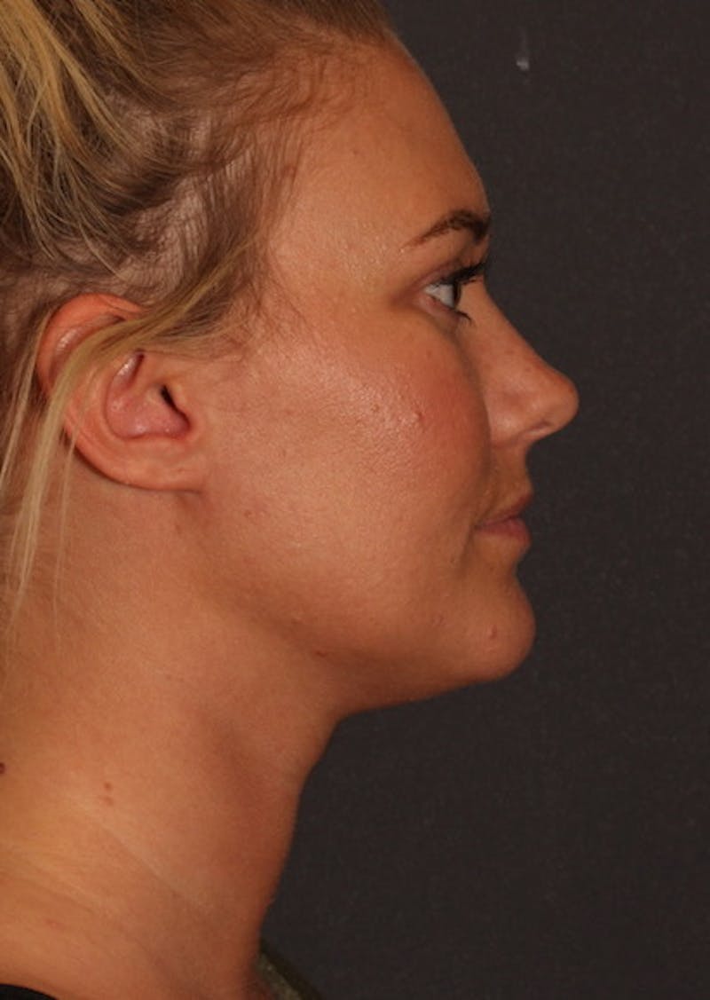 Facetite Before & After Gallery - Patient 106387115 - Image 2