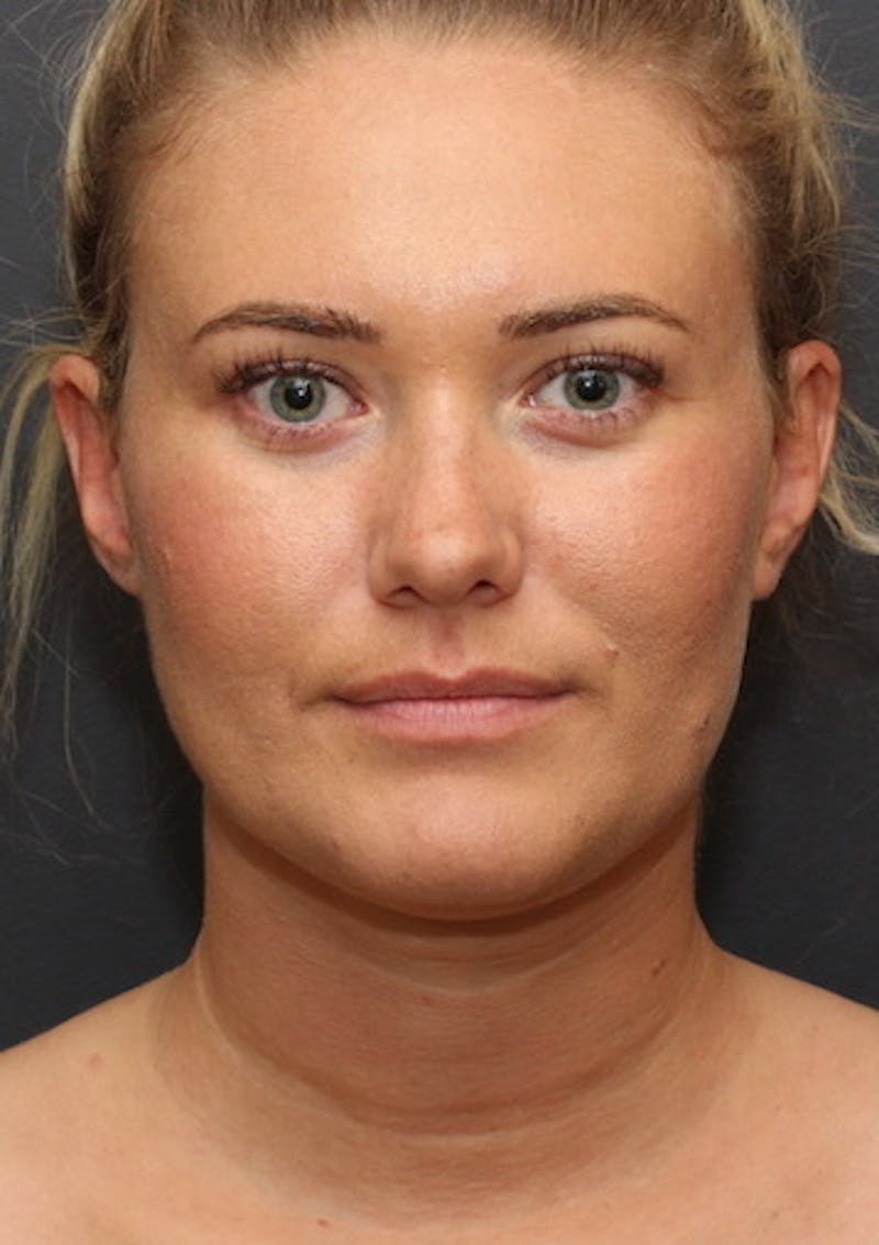 Facetite Before & After Gallery - Patient 106387115 - Image 6