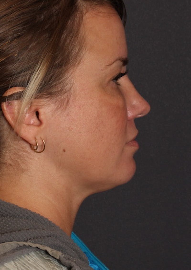 Facetite Before & After Gallery - Patient 106387149 - Image 1