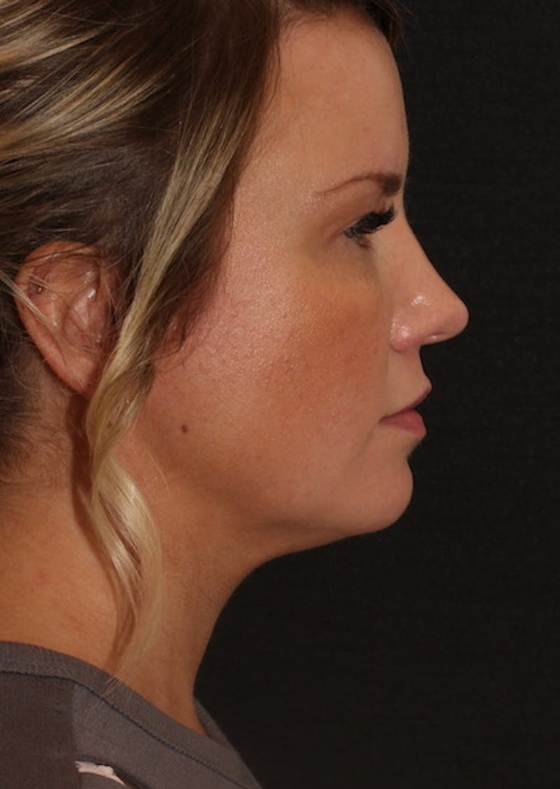 Facetite Before & After Gallery - Patient 106387149 - Image 2