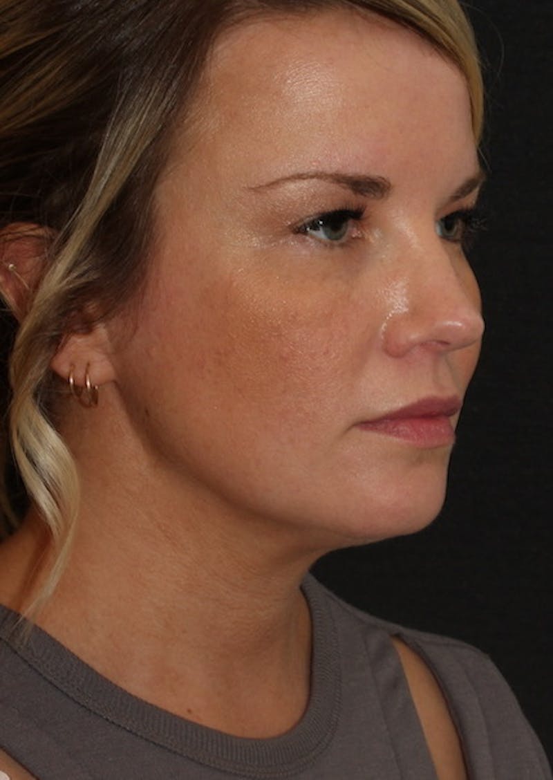 Facetite Before & After Gallery - Patient 106387149 - Image 4