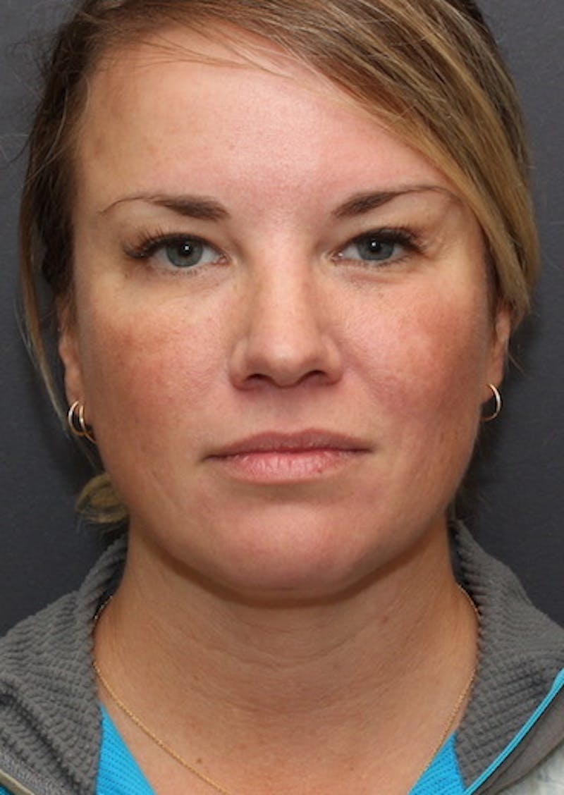 Facetite Before & After Gallery - Patient 106387149 - Image 5